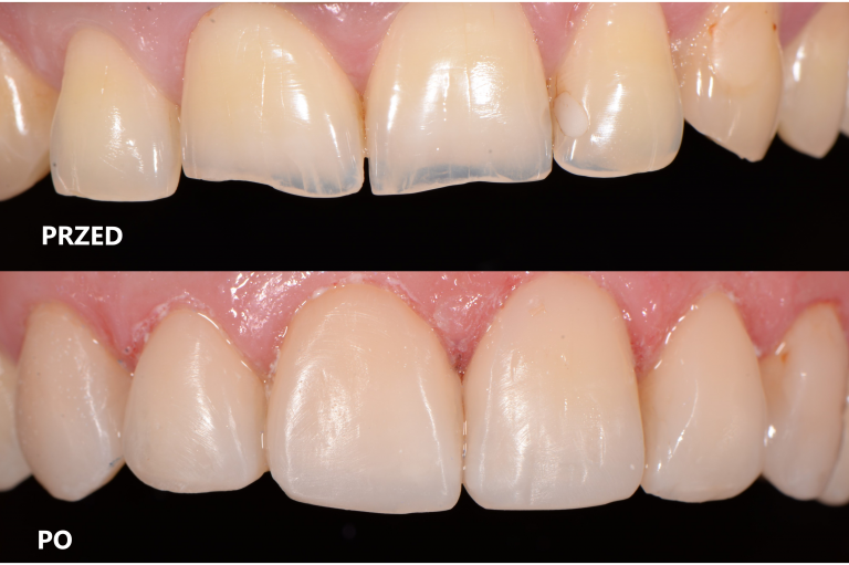przed i po